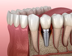 Dental implant in Coatesville in the lower jaw