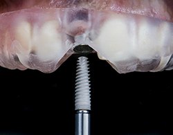 Dental implant surgical guide in Coatesville