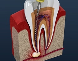 3D animation of a root canal procedure