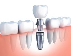A digital image of a single tooth dental implant and all its parts sitting in the lower arch of the mouth in Thorndale