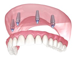 Animated smile with All-On-4 dental implants in Thorndale
