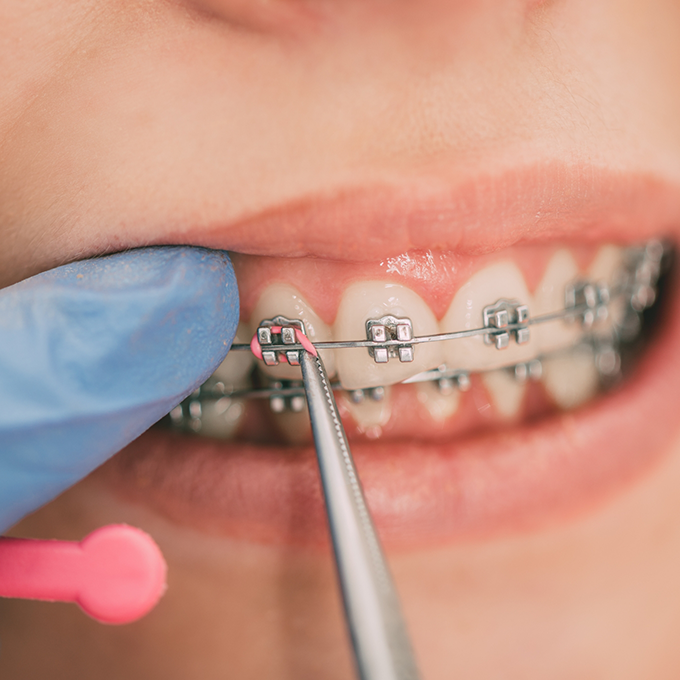 Placing bands on metal braces
