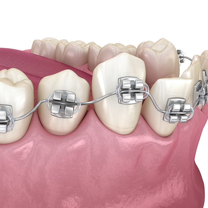 Illustration of crooked teeth with metal braces