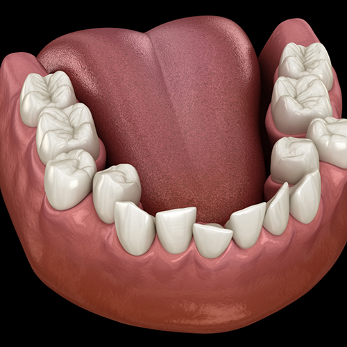 Illustration of significantly crooked teeth