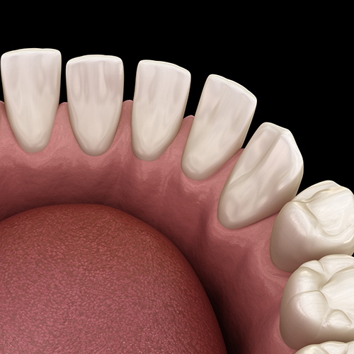 Illustration of gapped teeth in lower arch