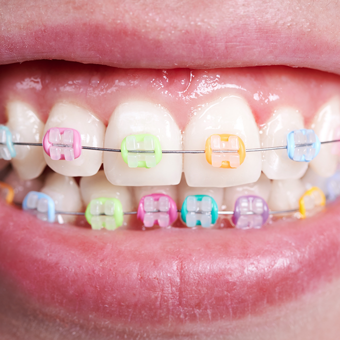 Metal braces with colorful bands