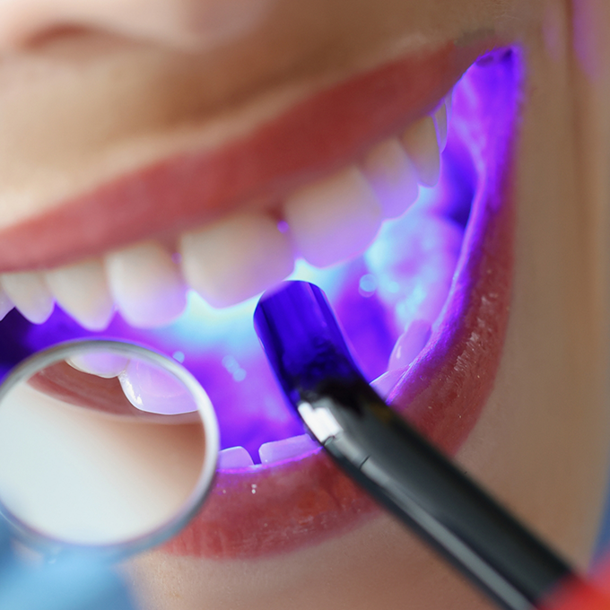 Patient's mouth during dental bonding procedure