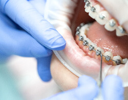 a mouth with braces