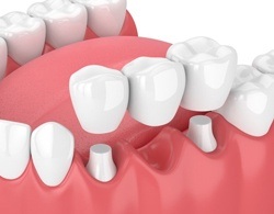 Animated dental bridge placement