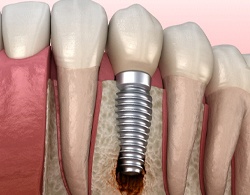 Failed dental implant in Coatesville