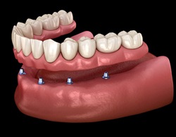 Animated dental implant-supported denture placement