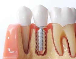 Dental implant model