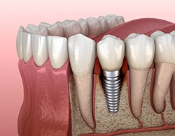 Dental implant in Thorndale in the lower jaw