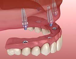 Animated smile during dental implant supported denture placement in Thorndale