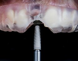 Dental implant surgical guide in Thorndale