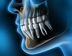 Digital images of dental implants in Thorndale
