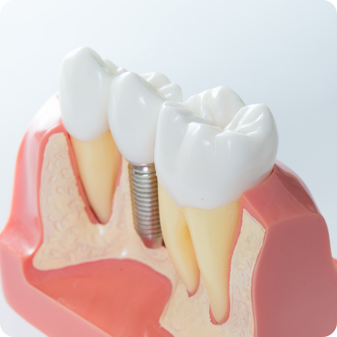 Model of a dental implant next to natural teeth