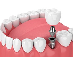 Diagram of single tooth dental implant in Thorndale