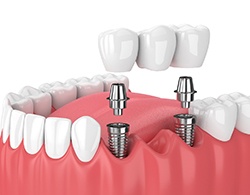 Diagram of dental implant bridge for multiple missing teeth in Thorndale
