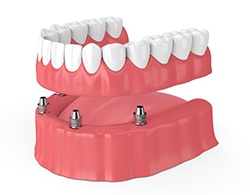 Diagram of dental implant dentures in Thorndale