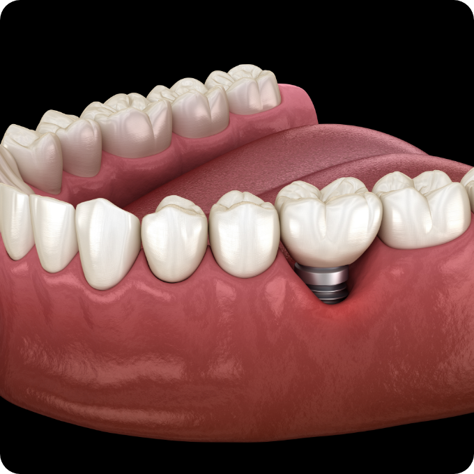 Dental implant post supporting a crown in the lower jaw