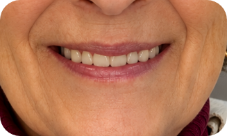 Smile after dental implants