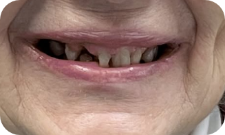 Smile before dental implants