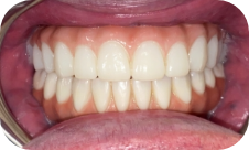 Smile after dental implants