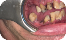 Smile before dental implants