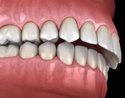 Illustration of an overbite