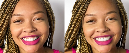 Young woman smiling before and after Invisalign treatment