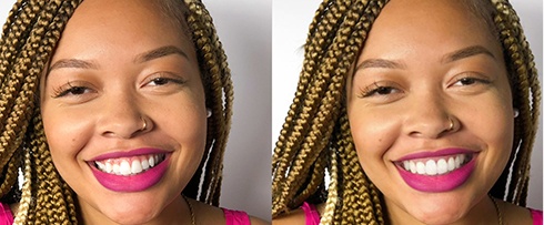 Young woman smiling before and after Invisalign treatment