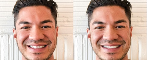Man smiling before and after Invisalign treatment