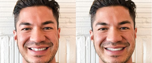 Man smiling before and after Invisalign treatment