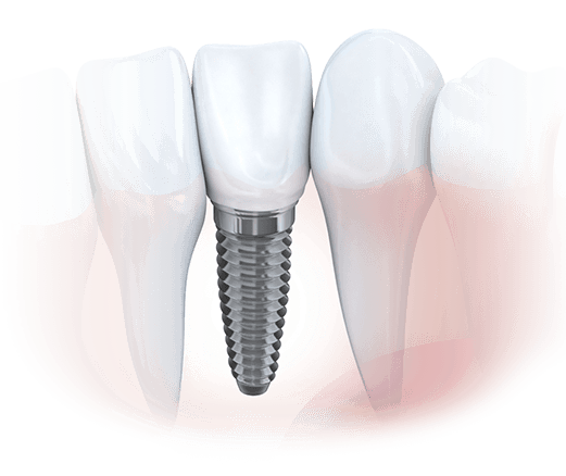Dental Implant Consultation Special Chester County
