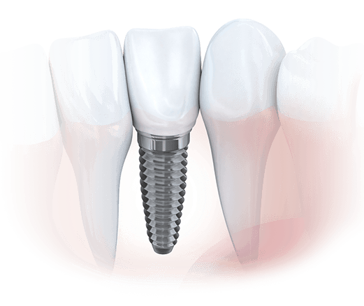 Image of tooth implant