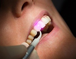 Patient receiving soft tissue laser dentistry