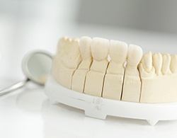 Model smile with dental crown supported fixed bridge