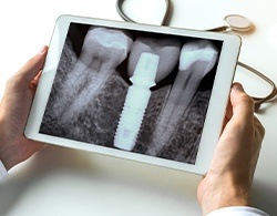 X-ray of dental implant supported replacement tooth