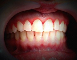 Red, inflamed gums before periodontal treatment