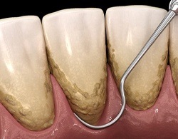 Image of a dental tool removing plaque and tartar buildup during scaling and root planing treatment