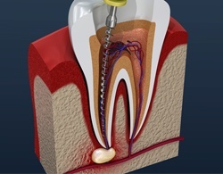 3D animation of a root canal procedure