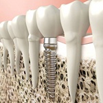 A diagram of an integrated dental implant