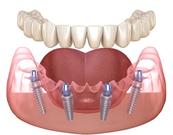 Animated smile with Teeth-In-A-Day in Coatesville