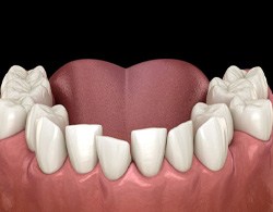 Illustration of crowded teeth in lower dental arch