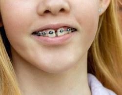 Gapped teeth with braces