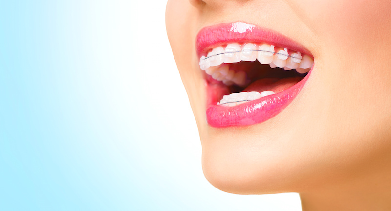 Beautiful woman smiling. Closeup ceramic braces on teeth