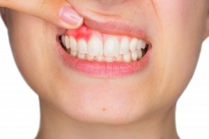 woman with pink spot on gums