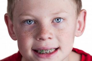 Young boy smiling with braces.