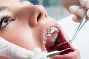 dental checkup with braces